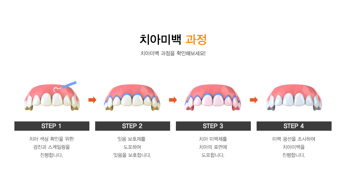 치아미백 과정